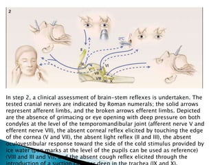 Coma or unresponsiveness--no cerebral motor response to pain in all extremities (nail-bed pressure and supraorbital pressure).    In step 1, the physician determines that there is no motor response and the eyes do not open when a painful stimulus is applied to the supraorbital nerve or nail bed.