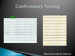 Confirmatory TestingCerebral AngiographyNormalNo Intracranial Flow