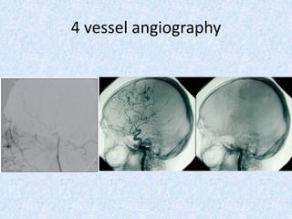 4 vessel angiography
 