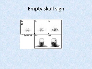 Empty skull sign
 