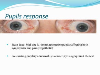 Pupils response
 Brain dead: Mid-size (4-6mm), unreactive pupils (affecting both
sympathetic and parasympathetic)
 Pre-existing pupilary abnormality Cataract ,eye surgery. limit the test
 