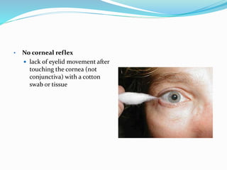 • No corneal reflex
 lack of eyelid movement after
touching the cornea (not
conjunctiva) with a cotton
swab or tissue
 