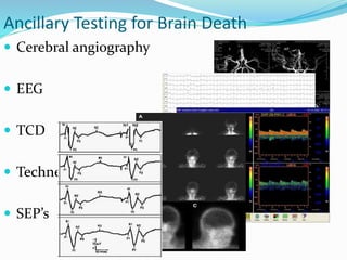 Ancillary Testing for Brain Death
 Cerebral angiography
 EEG
 TCD
 Technecium scan
 SEP’s
 