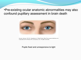 Pupils fixed and unresponsive to light
•Pre-existing ocular anatomic abnormalities may also
confound pupillary assessment in brain death
 