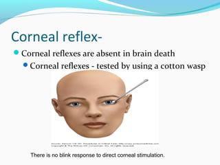 Corneal reflex-
Corneal reflexes are absent in brain death
Corneal reflexes - tested by using a cotton wasp
.
There is no blink response to direct corneal stimulation.
 