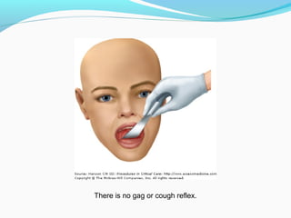 There is no gag or cough reflex.
 