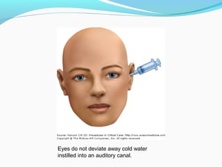 Eyes do not deviate away cold water
instilled into an auditory canal.
 