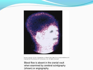 Blood flow is absent in the cranial vault
when examined by cerebral scintigraphy
(shown) or angiography.
 