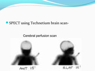 SPECT using Technetium brain scan-
Cerebral perfusion scan
 