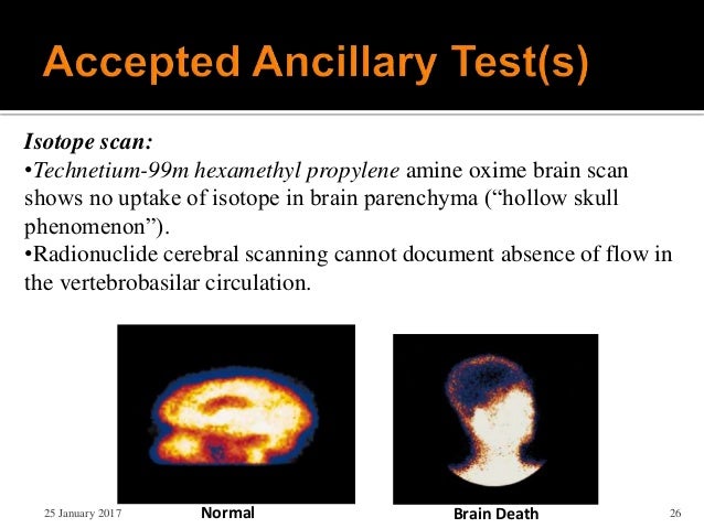 to brain blood flow test Brain donation organ and death
