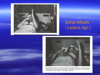 Spinal reflexes
( Lazarus sign )
 