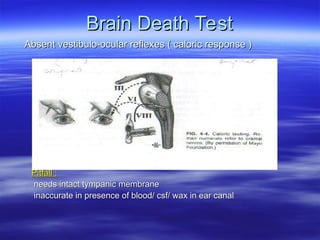 Brain Death Test
Brain Death Test
Absent vestibulo-ocular reflexes ( caloric response )
Absent vestibulo-ocular reflexes ( caloric response )
no nystagmus ( eye movements) in response to stimulation
no nystagmus ( eye movements) in response to stimulation
of the ear drum with 50 mls of ice cold water
of the ear drum with 50 mls of ice cold water
Pitfall :
Pitfall :
needs intact tympanic membrane
needs intact tympanic membrane
inaccurate in presence of blood/ csf/ wax in ear canal
inaccurate in presence of blood/ csf/ wax in ear canal
 