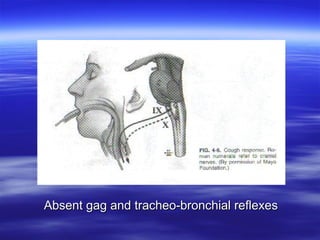 
Absent gag and tracheo-bronchial reflexes
Absent gag and tracheo-bronchial reflexes
 