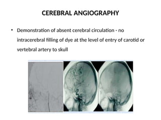 CEREBRAL ANGIOGRAPHY
• Demonstration of absent cerebral circulation - no
intracerebral filling of dye at the level of entry of carotid or
vertebral artery to skull
 