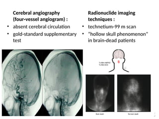 Cerebral angiography
(four vessel angiogram) :
‑
• absent cerebral circulation
• gold standard supplementary
‑
test
Radionuclide imaging
techniques :
• technetium 99 m scan
‑
• “hollow skull phenomenon”
in brain dead patients
‑
5
3
 
