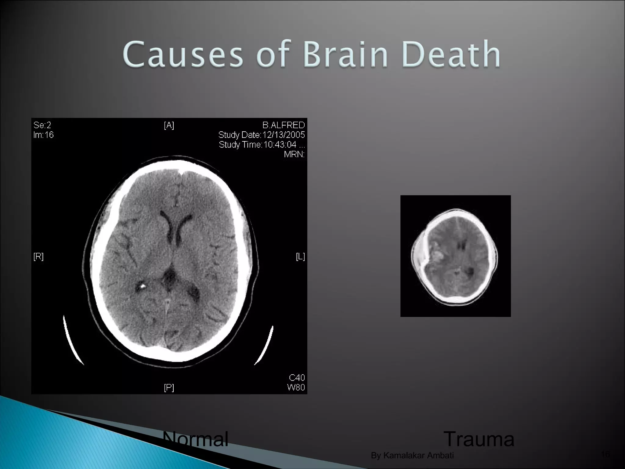 Brain death assessment basic principles | PPT