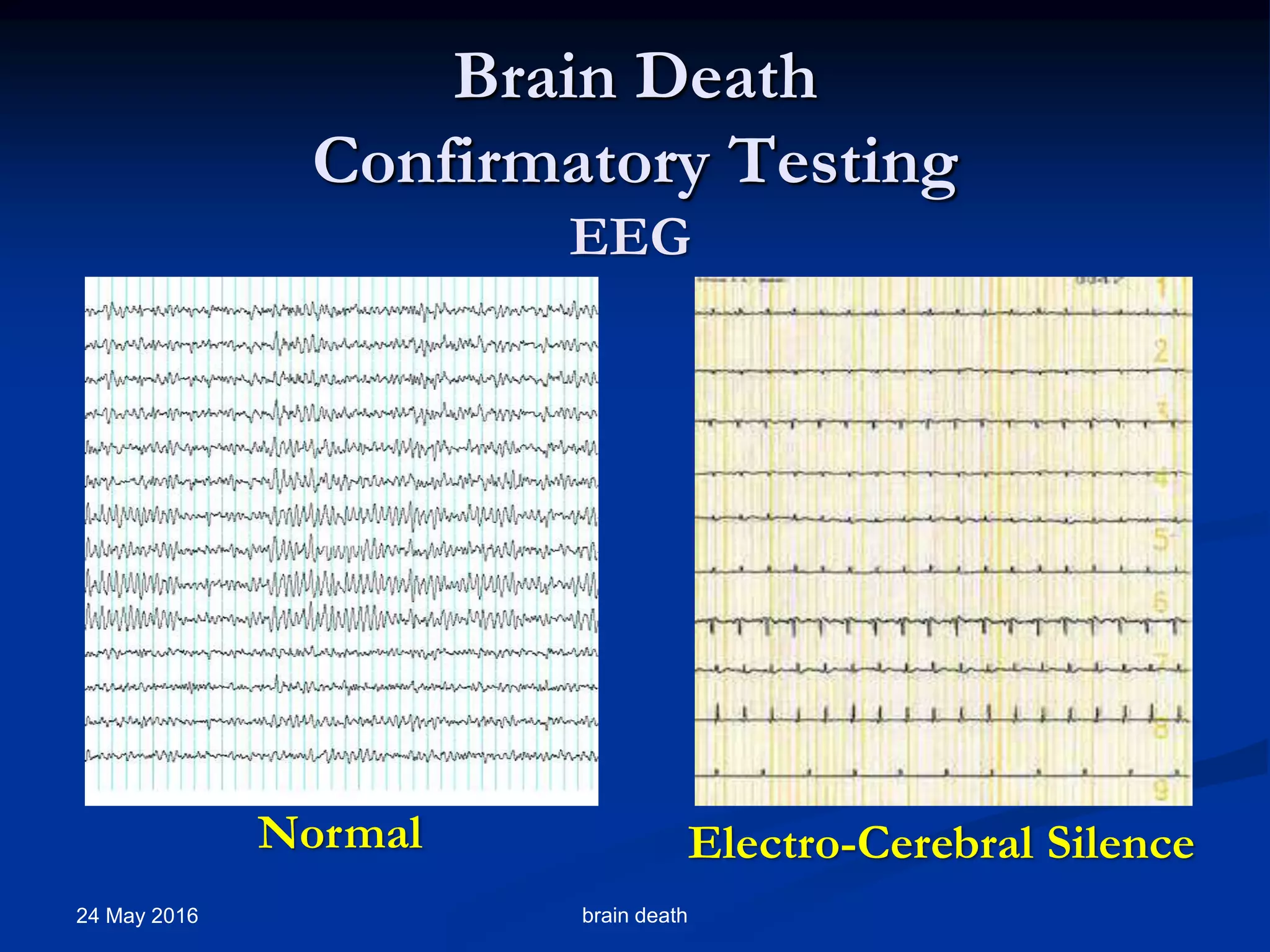 Brain Death Testing Machine Brain death presentation | PPTX