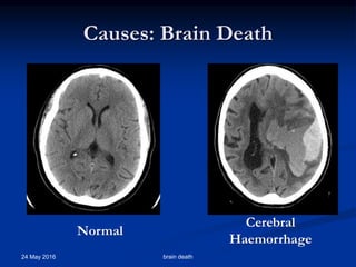 Causes: Brain Death
24 May 2016 brain death
Normal
Cerebral
Haemorrhage
 