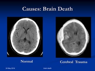 Causes: Brain Death
24 May 2016 brain death
Normal Cerebral Trauma
 