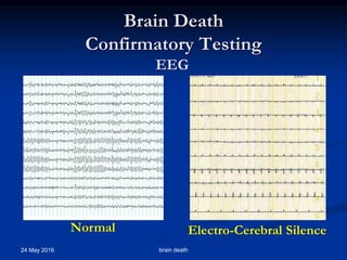Brain Death
Confirmatory Testing
24 May 2016 brain death
Electro-Cerebral SilenceNormal
EEG
 