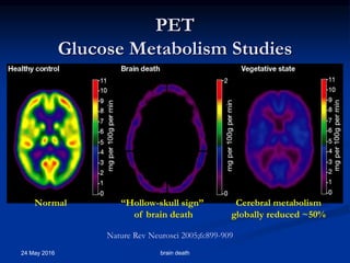 PET
Glucose Metabolism Studies
24 May 2016 brain death
“Hollow-skull sign”
of brain death
Cerebral metabolism
globally reduced ~50%
Normal
Nature Rev Neurosci 2005;6:899-909
 
