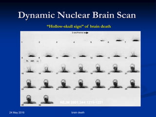 Dynamic Nuclear Brain Scan
24 May 2016 brain death
“Hollow-skull sign” of brain death
NEJM 2001;344:1215-1221
 