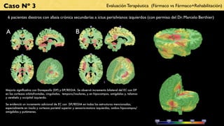 Caso Nº 3                                                                    Evaluación Terapéutica (Fármaco vs Fármaco+Rehabilitación)

 6 pacientes diestros con afasia crónica secundarias a ictus perisilvianos izquierdos (con permiso del Dr. Marcelo Berthier)


A                                                    B




Mejoría signiﬁcativa con Donepezilo (DP) y DP/REGIA. Se observó incremento bilateral del EC con DP
en las cortezas orbitofrontales, cinguladas, temporo/insulares, y en hipocampos, amígdalas y, talamos
y cerebelo y occipital izquierda.

Se evidenció un incremento adicional de EC con DP/REGIA en todas las estructuras mencionadas,
especialmente en ínsula y cortezas parietal superior y sensorio-motora izquierdas, ambos hipocampos/
amígdalas y putámenes.
 