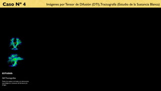 Caso Nº 4                                      Imágenes por Tensor de Difusión (DTI), Tractografía (Estudio de la Sustancia Blanca)




ESTUDIO:

264 Tractografías
Todos los sujetos normales, sin alteraciones
neurológicas ni consumo de fármacos y/o
drogas.
 