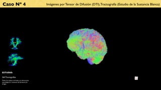 Caso Nº 4                                      Imágenes por Tensor de Difusión (DTI), Tractografía (Estudio de la Sustancia Blanca)




ESTUDIO:

264 Tractografías
Todos los sujetos normales, sin alteraciones
neurológicas ni consumo de fármacos y/o
drogas.
 