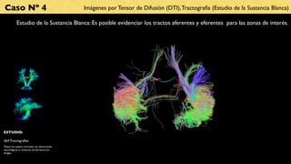 Caso Nº 4                                      Imágenes por Tensor de Difusión (DTI), Tractografía (Estudio de la Sustancia Blanca)

           Estudio de la Sustancia Blanca: Es posible evidenciar los tractos aferentes y eferentes para las zonas de interés.




ESTUDIO:

264 Tractografías
Todos los sujetos normales, sin alteraciones
neurológicas ni consumo de fármacos y/o
drogas.
 