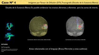 Caso Nº 4                                       Imágenes por Tensor de Difusión (DTI), Tractografía (Estudio de la Sustancia Blanca)

           Estudio de la Sustancia Blanca: Es posible evidenciar los tractos aferentes y eferentes para las zonas de interés.




                                               Conexiones dentro de las áreas seleccionadas   Conexiones con otras zonas cerebrales


ESTUDIO:

264 Tractografías
Todos los sujetos normales, sin alteraciones      Areas relacionadas con el lenguaje (Broca, Wernicke y areas auditivas)
neurológicas ni consumo de fármacos y/o
drogas.
 