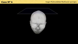 Caso Nº 6   Imagen Multimodalidad. Planiﬁcación quirúrgica.
 