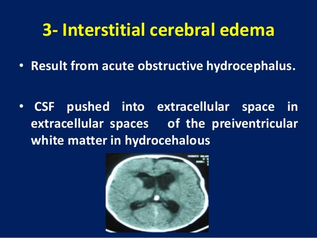 brain edema cerebral edema