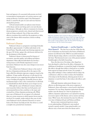 60 Society for NeuroScieNceBraiN factS | diseases and disorders
brain and appears to be associated with proteins involved
in transcription (turning genes on), protein turnover, and
energy production. Scientists suspect that Huntington’s
disease is caused by the gain of a new and toxic function
among these proteins.
Cell and animal models can replicate many features
of the disease and are now being used to test new theories
and therapies. Although no effective treatments for slowing
disease progression currently exist, clinical and observational
trials are being conducted. Any of these may yield an
effective treatment that would slow the progression or delay
onset of the disease while researchers continue working
toward a cure.
Parkinson’s Disease
Parkinson’s disease is a progressive neurological disorder
that affects approximately 1.5 million individuals in the
United States. Typically, people start showing symptoms over
the age of 50. In fact, aging is the only known risk factor for
the development of this disorder.
Parkinson’s disease is characterized by slowness of
movement, muscular rigidity, and walking and balance
impairment. Many affected individuals may develop a
resting tremor as well. Besides impairment in motor
movement, Parkinson’s may also cause changes in non-motor
brain function.
On a cellular level, Parkinson’s disease is the result of
the loss of dopamine-producing cells in the region of the
brain called the substantia nigra pars compacta, found in the
midbrain. A large number, 40 percent, of cells must be lost
before symptoms occur, suggesting that perhaps the brain has
a way of warding off symptoms. Eventually, however, these
mechanisms begin to fail, or the continued loss of cells leads
to a threshold from which the brain can no longer recover.
Although the cause of Parkinson’s remains unknown,
most researchers believe that there are both genetic and
environmental factors that contribute to the injury and
eventual loss of these dopamine-producing cells. While
most cases of Parkinson’s do not appear to be inherited,
there are certain situations in which genetic factors may be
involved. For example, studies indicate that cases of early
onset Parkinson’s may be inherited. Research on various
forms of the disease may help provide clues about it, as well
as insights into potential new treatments.
Treatment Breakthroughs — and the Need for
More Research The discovery in the late 1950s that the
level of dopamine was decreased in the brains of Parkinson’s
patients was followed in the 1960s by successful treatment
with the drug levodopa, which is converted to dopamine in
the brain. This historical event is one of the greatest medical
breakthroughs in the field of neurology.
Since the discovery of levodopa, other drugs have
been developed to either boost the effect of dopamine, by
inhibiting its breakdown, or extend the length of dopamine-
like effects, through their ability to bind and act on similar
brain regions for longer periods of time. For example, a
drug called carbidopa is often combined with levodopa; the
combination is effective in that it reduces the breakdown
of levodopa in the bloodstream, allowing greater levels of
dopamine to reach the brain. It also reduces side effects, such
as nausea.
Although dopamine replacement therapy is very
effective in alleviating many of the motor symptoms of
Parkinson’s, there still remains a critical need to find better
treatments. For one thing, dopamine replacement therapy
neither cures the disease nor slows its progression. In
addition, dopamine replacement is not optimal for treating
non-motor aspects of the disease, such as anxiety and sleep
issues. What’s more, this treatment becomes less effective
over time in helping with gait and balance problems.
Because many unanswered questions remain
in our understanding of Parkinson’s, more medical
research is greatly needed. Using animal models is an
effective way to learn more about the disease and to
Deep brain stimulation shows promise at relieving symptoms for some
people with Parkinson’s disease. As shown in the X-ray image, the therapy
uses an implanted electrode to deliver electrical impulses deep within the
brain. [Credit: Courtesy of Robert S. Fisher, MD, PhD, Stanford Neurology and
Jaimie henderson, MD, PhD, Stanford Neurosurgery.]
 