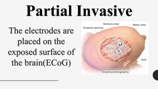Partial Invasive
The electrodes are
placed on the
exposed surface of
the brain(ECoG)
 