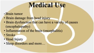 • Brain tumor
• Brain damage from head injury
• Brain dysfunction that can have a variety of causes
(encephalopathy)
• Inflammation of the brain (encephalitis)
• Stroke
• Head Injury
• Sleep disorders and more…
Medical Use
 