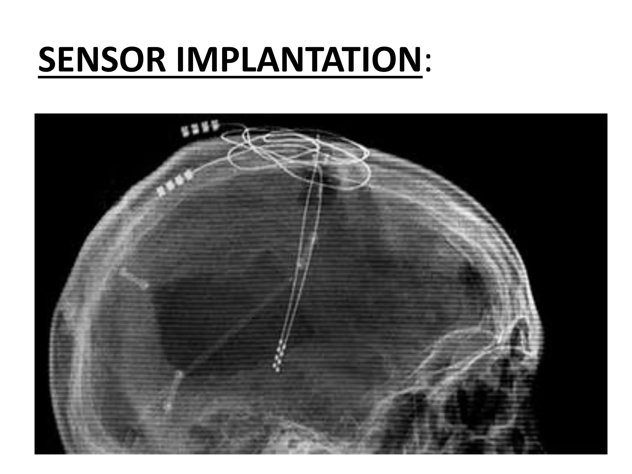 SENSOR IMPLANTATION:
 