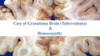 Granuloma brain (Tuberculoma) & Homoeopathy ( दिमाग कि गांठ, ब्रेन ट्यूमर का होम्योपैथी उपचार) 