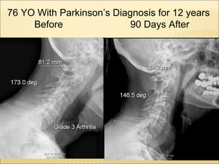 76 YO With Parkinson’s Diagnosis for 12 years
Before 90 Days After
 