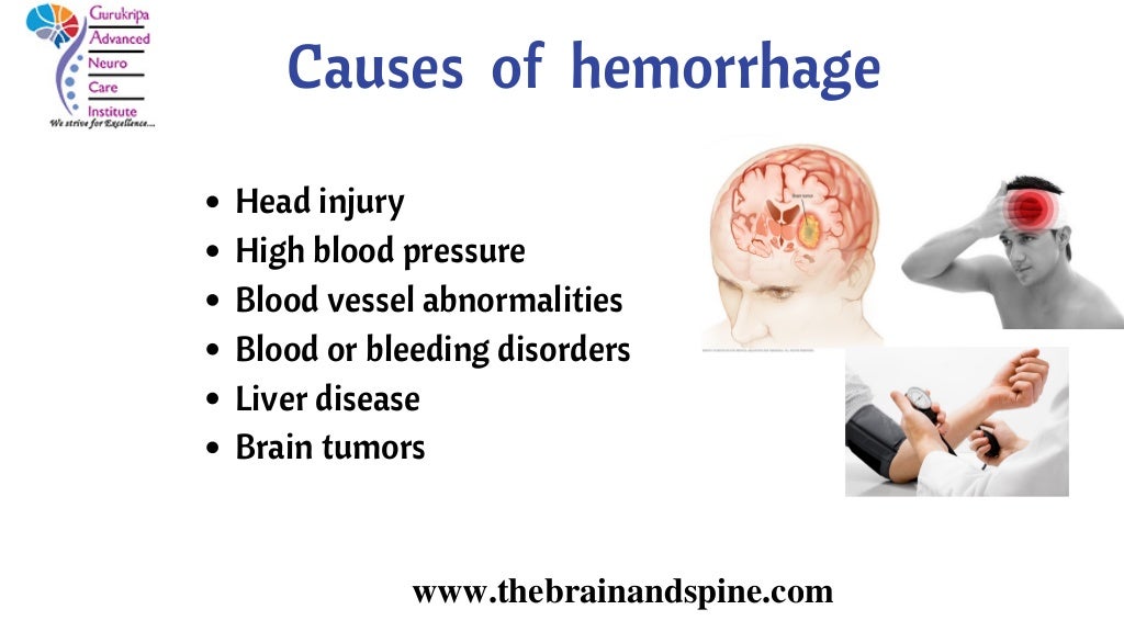 Brain Hemorrhage Treatment In Uttar Pradesh Best Neurologist In Ind 