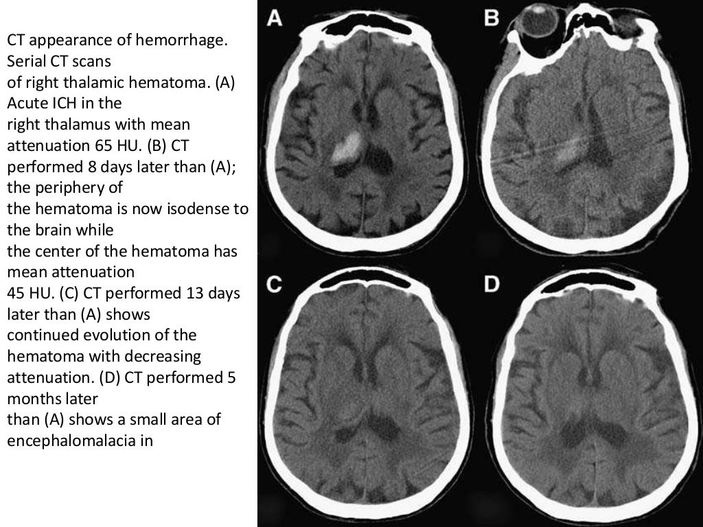 Radiology of Brain hemorrhage vs infarction
