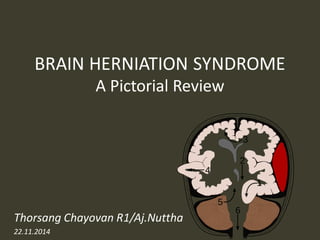 BRAIN HERNIATION SYNDROME A Pictorial Review 
Thorsang Chayovan R1/Aj.Nuttha 
22.11.2014  