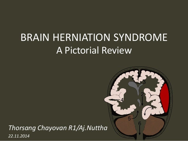 brain herniation