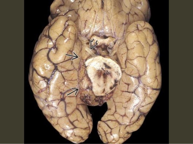 brain herniation