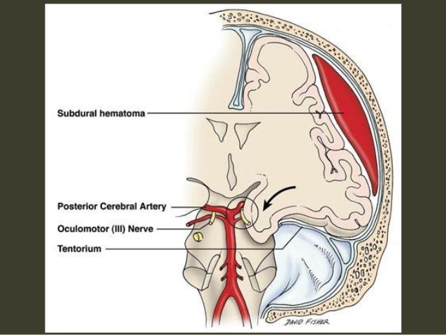 brain herniation