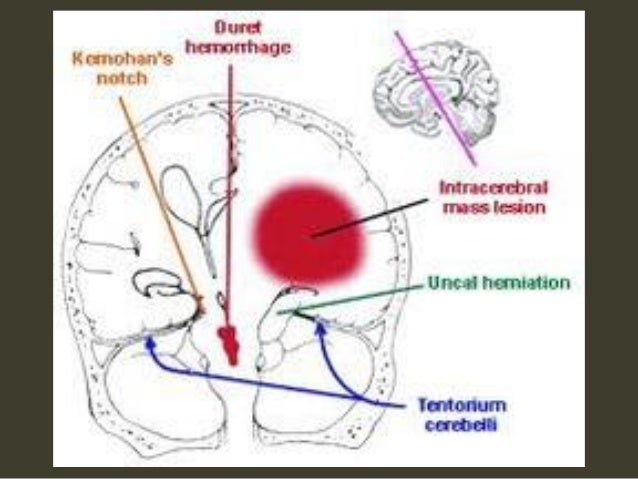 brain herniation