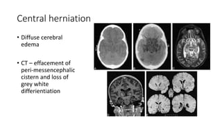 Central herniation
• Diffuse cerebral
edema
• CT – effacement of
peri-messencephalic
cistern and loss of
grey white
differientiation
 