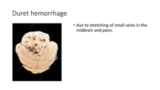 Duret hemorrhage
• due to stretching of small veins in the
midbrain and pons.
 