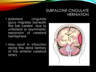 Subfalcine BRAIN HERNIATION Pathology classes q.pptx