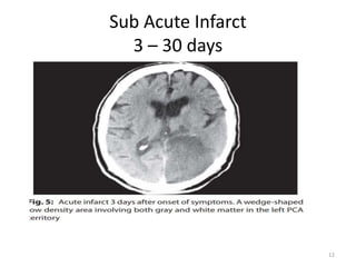 Sub Infarct Brain Imaging.pptx